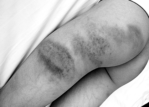 陽(yáng)陽(yáng)身上的傷讓人不忍心看 陽(yáng)陽(yáng)身上的傷讓人不忍心看