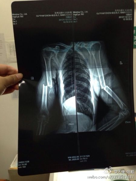 圖為微博上傳“范某某的妻子顧盤珍手被打斷?！? width=