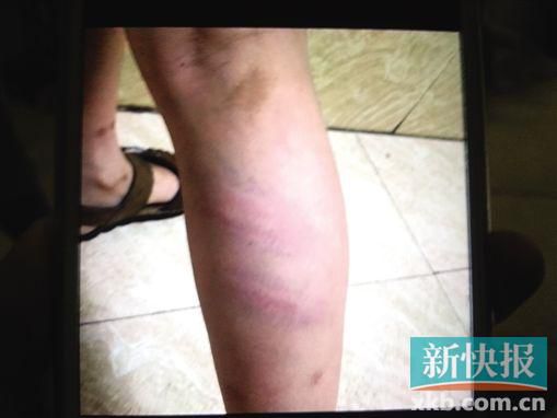小宇腿部有明顯瘀痕。 翻拍自家屬手機(jī)