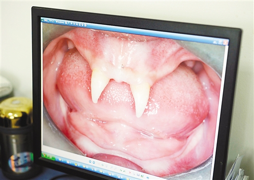 貴州：16歲男孩身患罕見基因病只長(zhǎng)兩顆“獠牙”