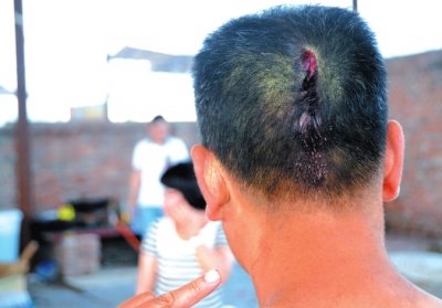 崔先生頭部受傷。京華時報記者趙思衡攝/視頻