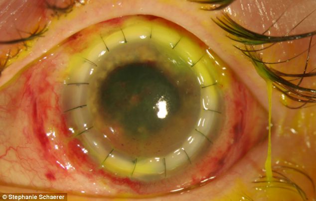 恐怖慎入！隱形眼鏡致英女子摘除眼球