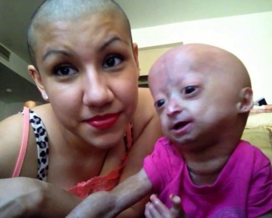 女童患罕見早衰癥 女童患罕見早衰癥