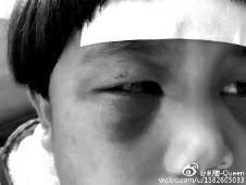 6月2日，網(wǎng)曝渭南市臨渭區(qū)一不滿5歲的女童遭奶奶毆打，眼圈青腫，引起網(wǎng)友關(guān)注，但孩子父母和爺爺均稱是摔倒導(dǎo)致。相關(guān)部門介入調(diào)查發(fā)現(xiàn)確為奶奶毆打所致，鑒于其身體原因已進行批評教育。