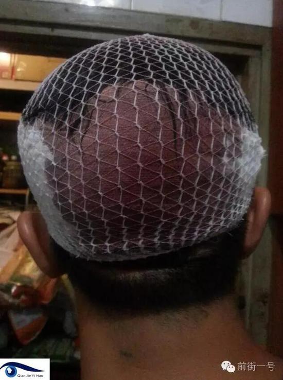 李律師受傷后縫合三針。