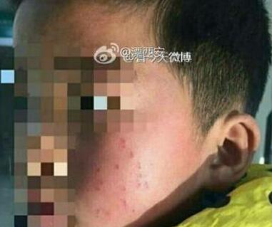 小學校長筆扎學生左臉17個眼 激怒網(wǎng)友:教育界禽獸滾粗