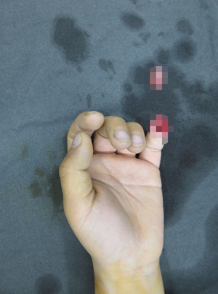 嚇哭！6歲男孩被夾斷手指 罪魁禍?zhǔn)拙故切７? oldsrc=