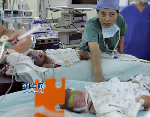 一對(duì)連體女?huà)氤晒Ψ蛛x