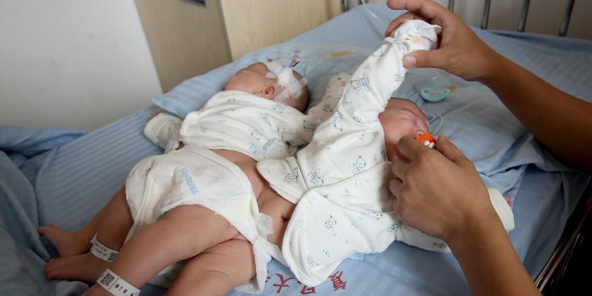 一對(duì)連體女?huà)氤晒Ψ蛛x