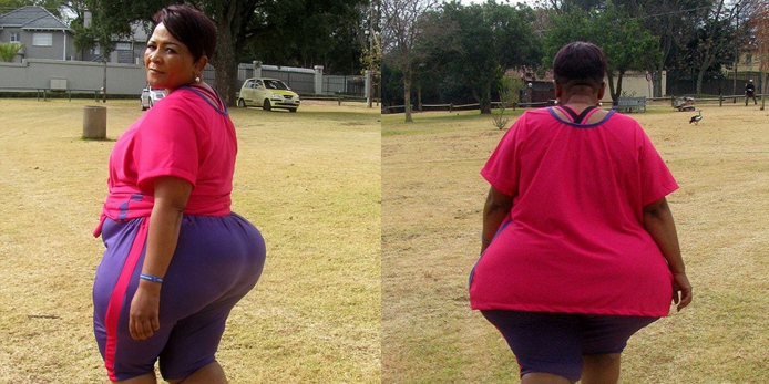 南非50歲女子臀部異常肥大遭歧視 南非50歲女子臀部異常肥大遭歧視