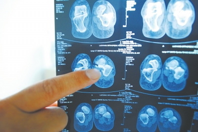 X光片顯示,確實(shí)有一根殘留的螺絲釘。