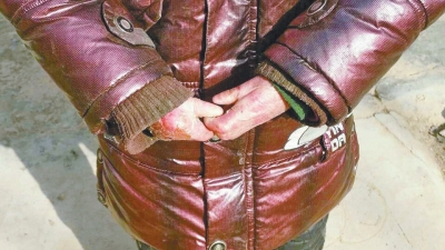 長(zhǎng)期受損的手指，已經(jīng)長(zhǎng)在了一起。