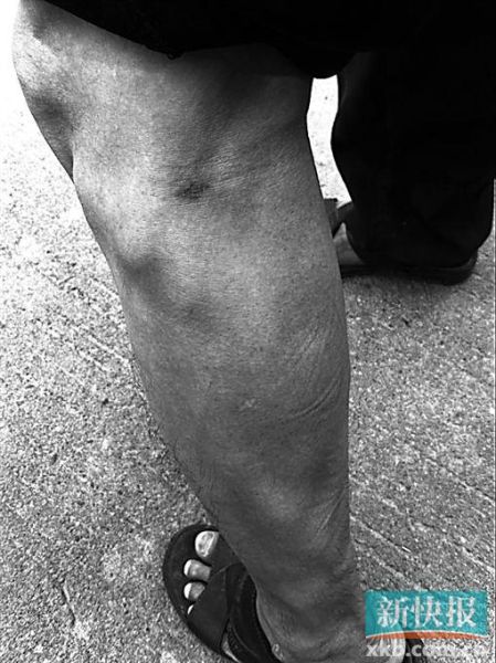 傷者身上遺留的彈痕。