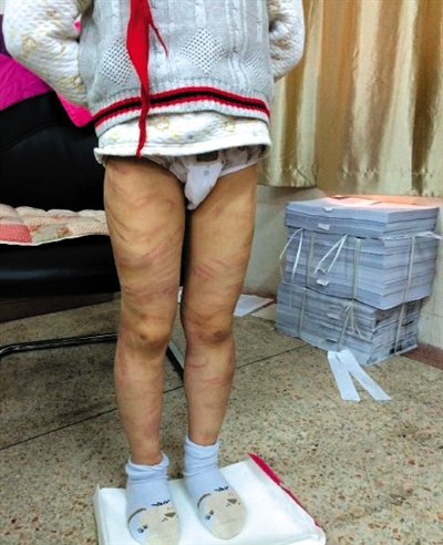 4月3日晚，微博網(wǎng)友“@朝廷半日閑”發(fā)圖文微博展示男童被虐待的慘狀。 微博截圖