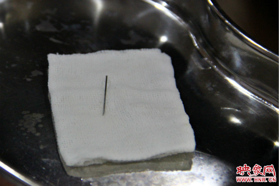 上午11點30分許，小龍腦中鋼針已經(jīng)成功取出。