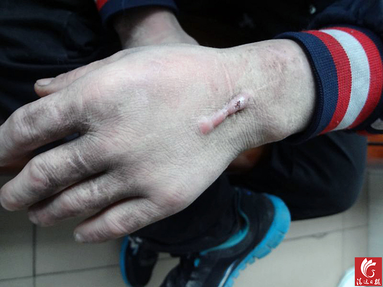 被發(fā)現(xiàn)男子手上的傷疤。