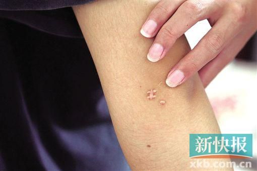 取出針后李星兒手臂留下了傷口。新快報記者 張國鋒/攝