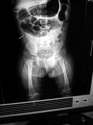 目前體內(nèi)的12根鋼針多分布在孩子的臀部，一根在腹部，其余3根在胸腔附近，其中一根很接近心臟