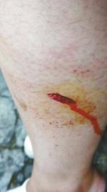 郭女士腿上被猴子咬的傷口。(受訪者供圖)