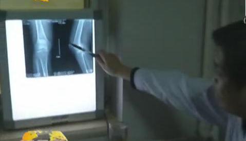 冷空氣來(lái)襲 如何預(yù)防老寒腿？